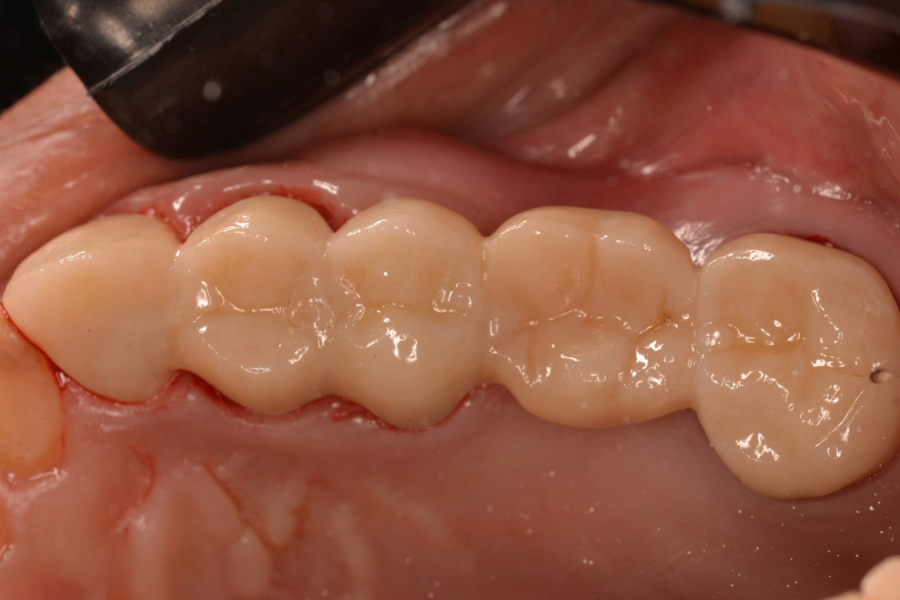 بعد تركيبات اسنان